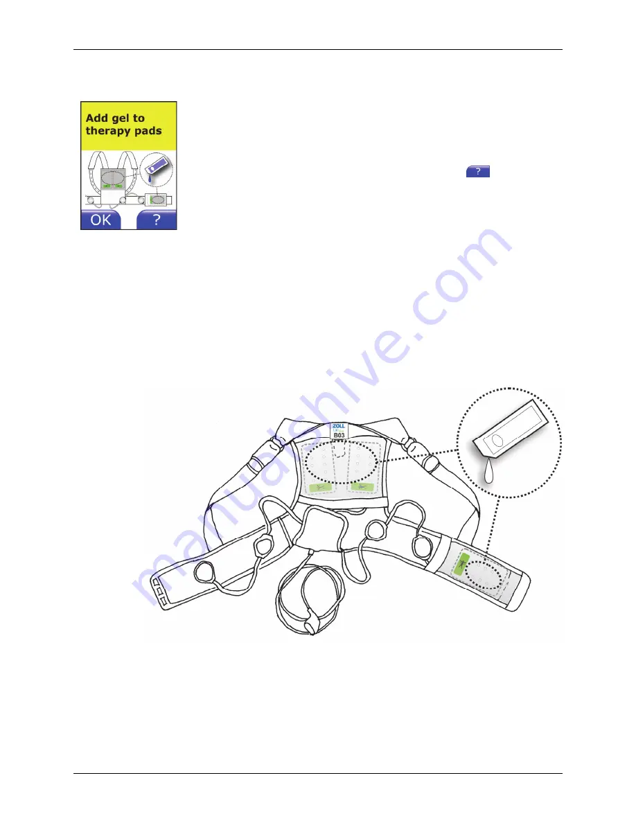 ZOLL LifeVest 4000 Patient Manual Download Page 95