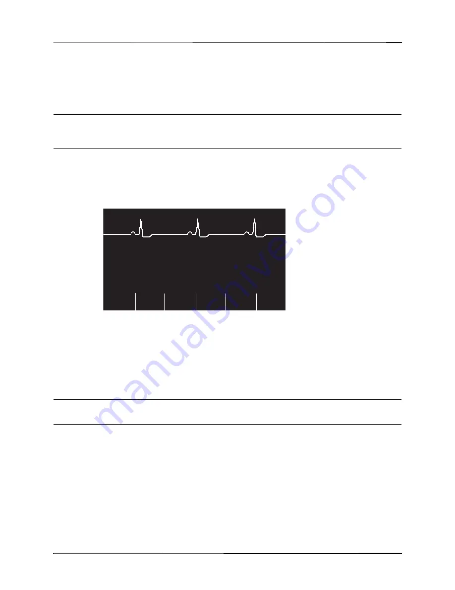 ZOLL R Series Operator'S Manual Download Page 57