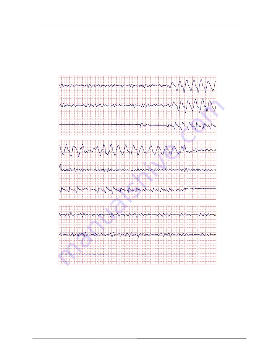 ZOLL R Series Operator'S Manual Download Page 78